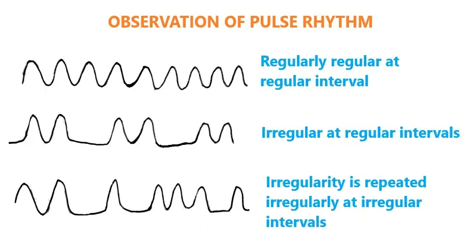 PULSE RHYTHY-RADIAL PULSE AND ITS CLINICAL METHOD OF EXAMINATION