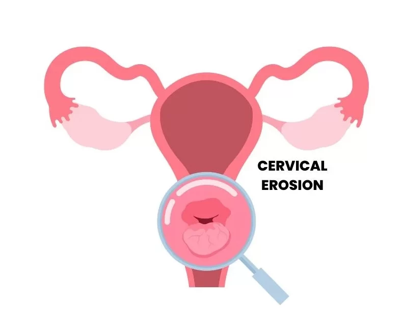 CERVICAL EROSION TREATMENT IN HOMOEOPATHY Women s Health