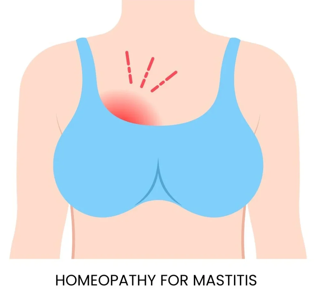 HOMEOPATHY FOR MASTITIS (BREAST INFLAMMATION): COMPLETE NATURAL HEALING GUIDE