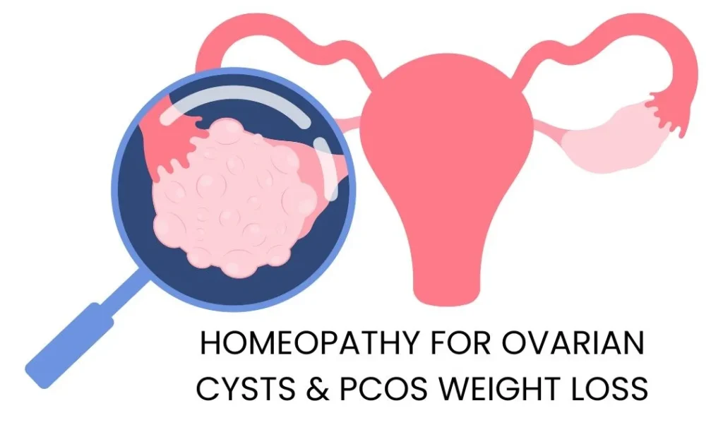 HOMEOPATHY FOR OVARIAN CYSTS & PCOS WEIGHT LOSS: A NATURAL, HOLISTIC APPROACH