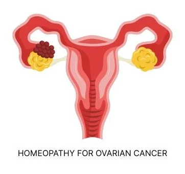 HOMEOPATHY FOR OVARIAN CANCER: A NATURAL APPROACH