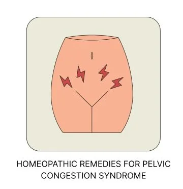 HOMOEOPATHIC MEDICINES FOR PELVIC CONGESTION SYNDROME