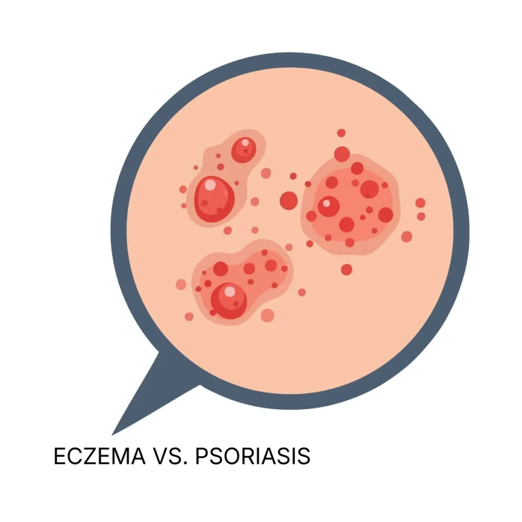 Home | Medicosage ECZEMA VS. PSORIASIS HOMEOPATHIC DIFFERENCES EXPLAINED